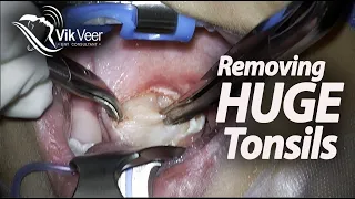 Watch Tonsils & Adenoids being Removed. Adenotonsillectomy.