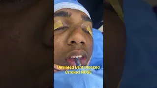 Crooked Blocked Bent Nose Correction by plastic surgery JOB - Rhinoplasty