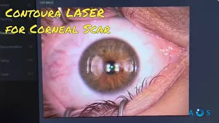 Contoura LASER Vision Correction for Corneal Scar - PTK and topo-guided PRK surgery
