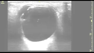 Vitreous hemorrhage ultrasound overgained. Video 2. JETem 2022