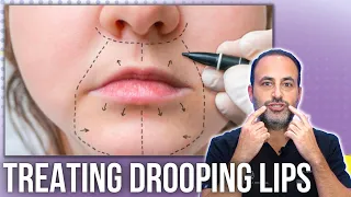 Defying Gravity: Treating Drooping Lips with Expert Insights | Lesson of the Day