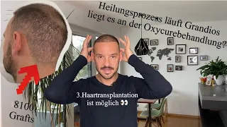 4 Wochen nach der Haartransplantation in Istanbul / Super Heilungsverlauf dank Oxycure