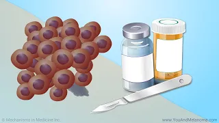 Treating Melanoma