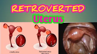 RETROVERTED UTERUS | How To Get Pregnant? | Tagalog