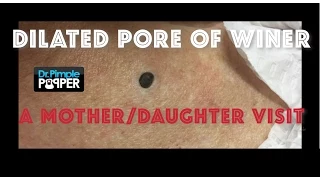 A giant blackhead extracted in an 85 y.o accompanied by her daughter.