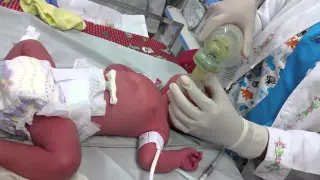 Intubación neonatal