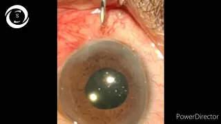 Anterior chamber paracentesis