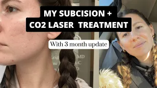 Getting a subcision + ablative CO2 Laser treatment | 3 month update