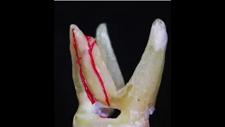 Одонтогенный гайморит как истинная эндо-патология. Удаление "кисты" зуба. Периодонтит Гранулема зуба