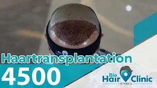 Haartransplantation Türkei - Bio Hair Clinic Istanbul | Mega Sitzung