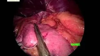 Laparoscopic Gastric Bypass