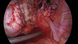 Ovarian Endometrioma - Laparoscopic Surgery | Dr Kunal Rathod