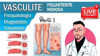 Poliarterite Nodosa │ Fisiopatologia das Vasculites  (Parte 1)