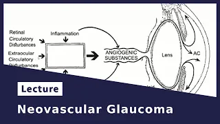 Neovascular Glaucoma