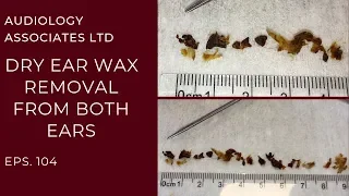 DRY EAR WAX REMOVAL FROM BOTH EARS - EP 104