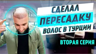 Пересадил волосы в Турции за 1000 $ | Облысение | Серия 2