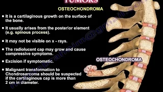 Cervical Spine Conditions, TUMORS - Everything You Need To Know - Dr. Nabil Ebraheim