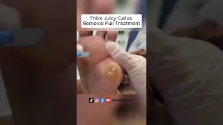 Ultimate Callus Removal: Full Treatment For Smooth Feet | FootClinicLondon.co.uk