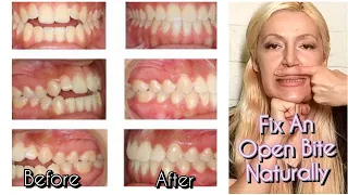 How To Fix An Open Bite Naturally No Braces No Surgery