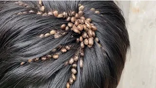 Do ticks like being in your hair?