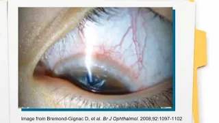 Vernal Keratoconjunctivitis: A Case Based Discussion with Drs. Halleran & Resnick