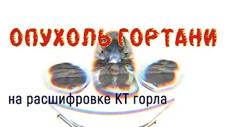 Образование гортани (опухоль) на расшифровке КТ горла