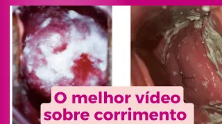 O melhor vídeo sobre corrimentos / Dra Roberta Gomes