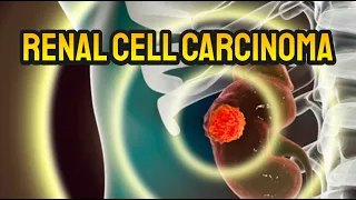 Renal Cell Carcinoma (Kidney Cancer) - CRASH! Medical Review Series