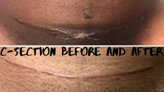 C section recovery tips ( how I cleaned my scar)