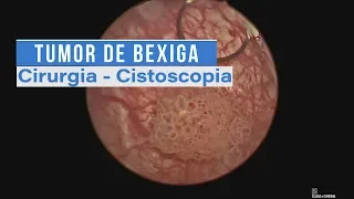 Tumor de Bexiga - Cirurgia | Cistoscopia