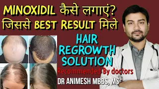 8 TIPS How to use Minoxidil for hair regrowth.Most effective hair regrowth solution with 100% result