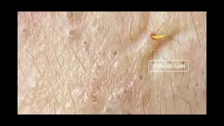 Years-old Blackhead Behind The Ear Extracted | CONTOUR DERMATOLOGY