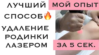 ЛАЗЕРНОЕ УДАЛЕНИЕ РОДИНКИ / МОЙ ОПЫТ