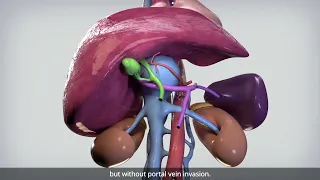 Segments 1/6/7 ex vivo liver resection with veno-veno bypass for caval sarcoma | TVASurg