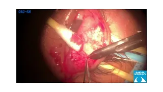 Mucous Membrane Grafting (MMG) for Refractory GPC in VKC