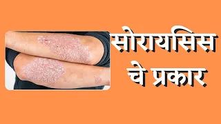 Types of Psoriasis, Psoriasis, Psoriasis Treatment, Psoriasis Types, Dr Shivratna Shete