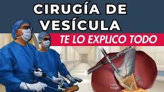 CIRUGÍA DE VESÍCULA - Colecistectomía Laparoscópica - Lo que debes saber