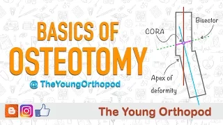 Basics of Osteotomy