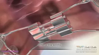 Orthodontic Appliance - RPE (Rapid Palatal Expander)