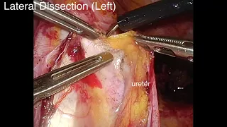 Combined laparoscopic and transperineal total pelvic exenteration with en bloc resection of urethra