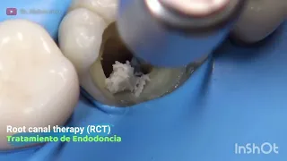 AMAZING reconstruction😱😳 of tooth damaged by caries: Endodontics|credit  Dr.Abdom fora