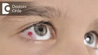 What is a fungal eye infection? - Dr. Sunita Rana Agarwal