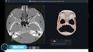 Axial CT through the Paranasal Sinuses | مقاطع معترضة في جيوب الأنف