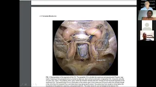 Endoscopic Approach to the Cavernous Sinus