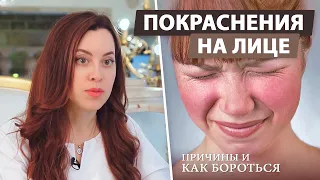 Как бороться с расширенными сосудами на лице