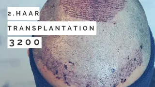 2. Haartransplantation Elithairtransplant Erfahrung
