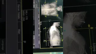 high resolution (HR)chest ct scan