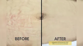 Fractional CO2 Laser: Say Goodbye To Stretch Marks | Shinagawa Aesthetics