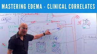 Mastering Edema - Types, Causes, Symptoms & Treatment