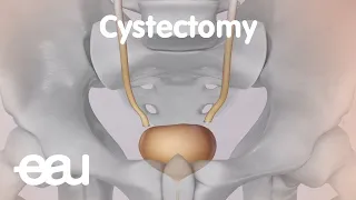 Bladder cancer treatment: Cystectomy